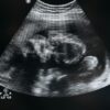 Revvity Launches SuperFlex Prenatal Screening System, Expand