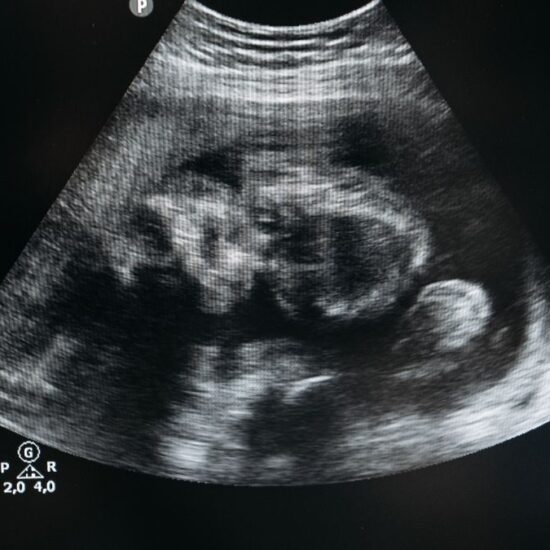 Revvity Launches SuperFlex Prenatal Screening System, Expand