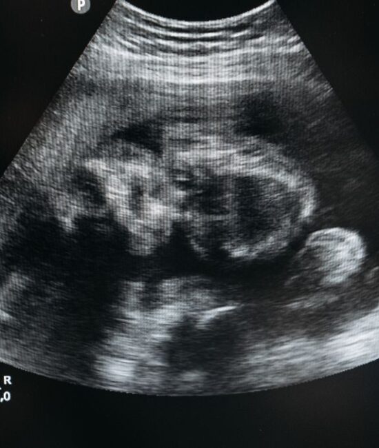 Revvity Launches SuperFlex Prenatal Screening System, Expand