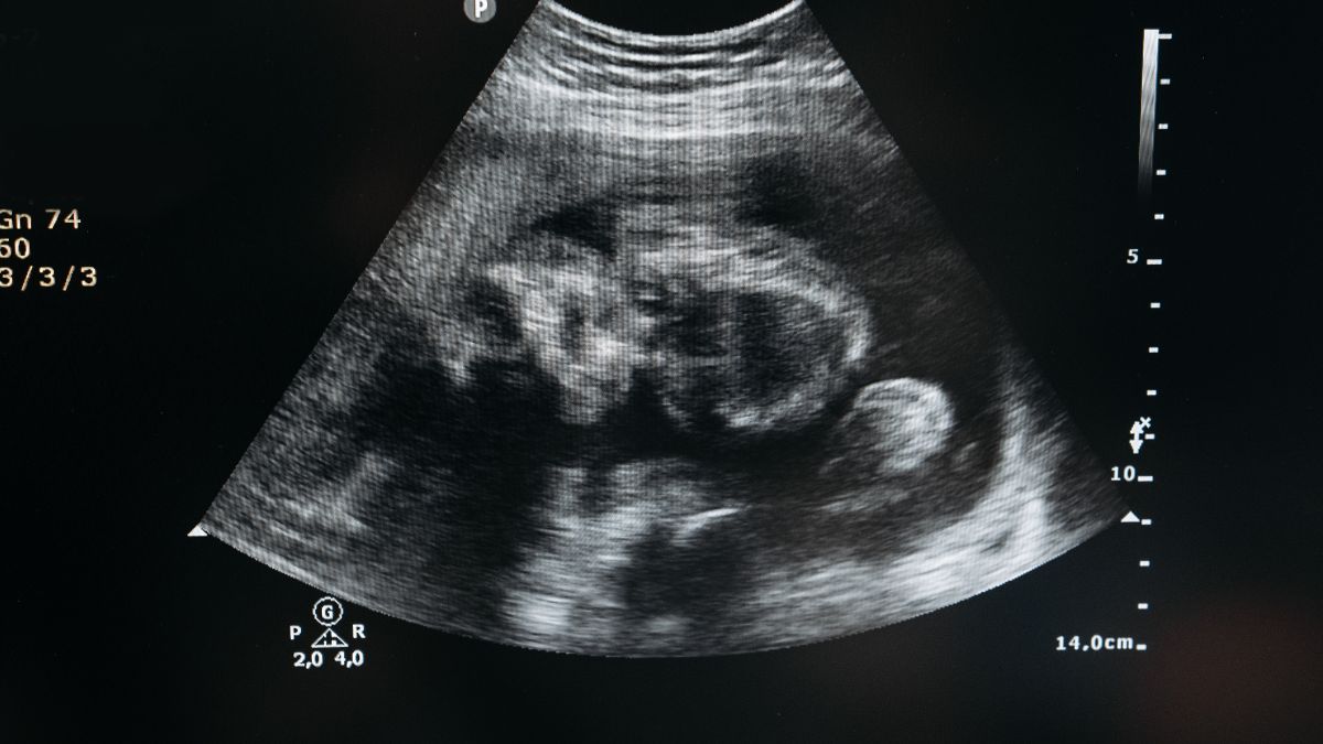 Revvity Launches SuperFlex Prenatal Screening System, Expand